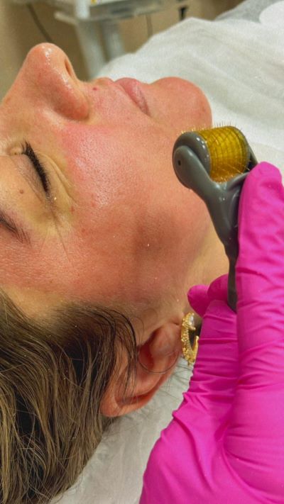Microagulhamento facial - um dos tratamentos faciais não invasivos para ativação do colágeno