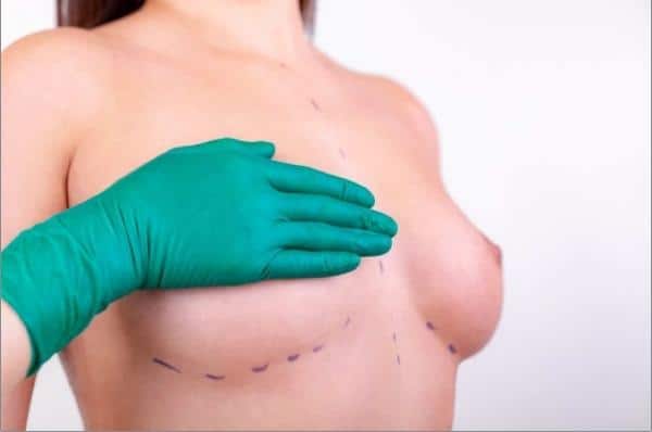 marcação dos seios para mamoplastia de aumento