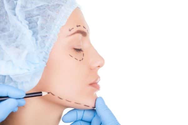 Mulher sendo preparada para cirurgia de blefaroplastia associada ao lifting facial.