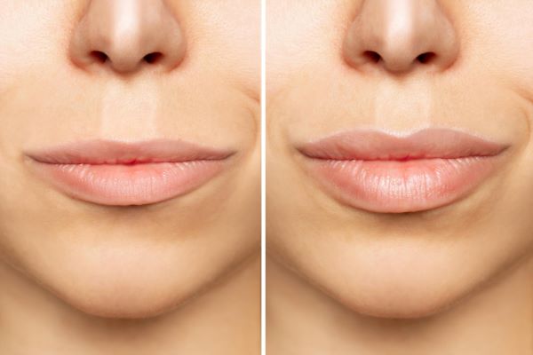 Antes e depois de um preenchimento dos lábios