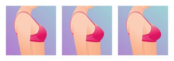 Seios femininos em sutiã antes e depois do aumento. Conceito de mamoplastia.