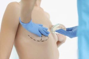 Mastopexia com próteses de siliconne. Dr. marca o seio de paciente e mostra o tipo de próteses de silicone que irá utilizar.