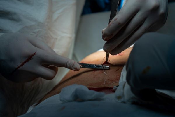 Mãos do médico, com luvas cirúrgicas, realizando a sutura após a realização de cirurgia.