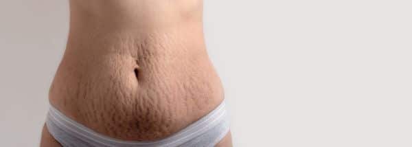 Close de uma barriga feminina com muitas estrias e flacidez. 