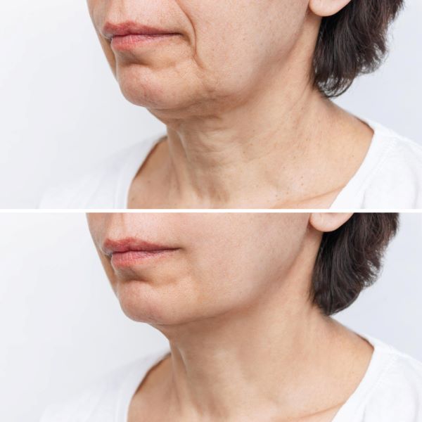 Antes e depois: close da metade do rosto de uma mulher que realizou o tratamento facial  com Morpheus no terço inferior da face e no pescoço.