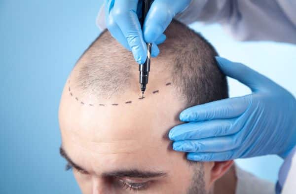 Cabeça de um homem sendo marcada na região que receberá transplante capilar pelas mãos de um médico cirurgião que usa luvas azuis. 
A alopecia é uma doença que atinge especialmente os homens.
