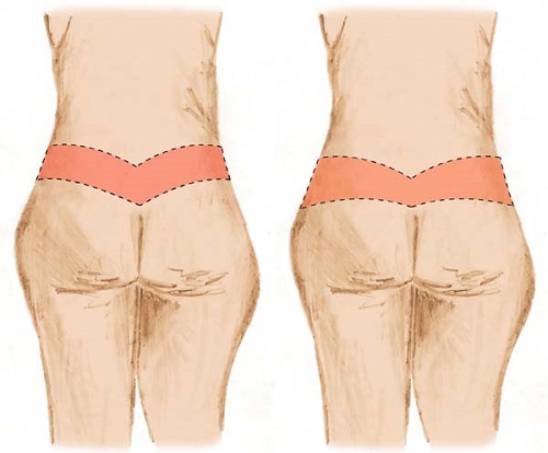 Vetores (desenho) do corpo feminino com marcas pré-cirúrgicas de abdominoplastia circunferencial total.