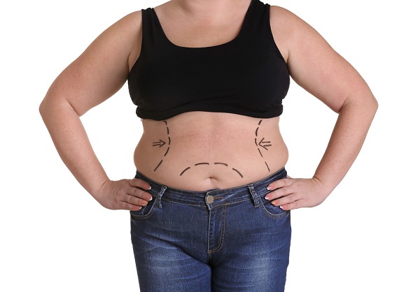 Close de metade do corpo de uma mulher com excesso de peso, marcada para realizar uma cirurgia plástica.