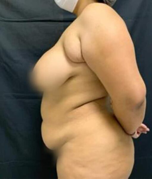 Abdominoplastia circunferencial em paciente com grande perda de peso. 
ANTES