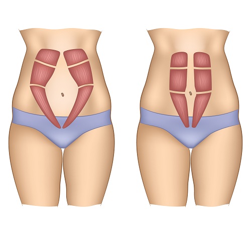 Vetores de corpo feminino apresentando a musculatura do abdômen com diástase e sem diástase.