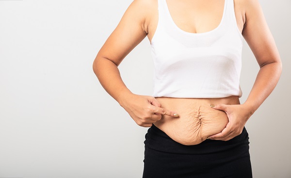 Close da metade do corpo de uma mulher, apresentando grande flacidez abdominal pós-gestação.