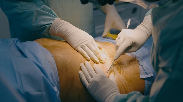 Abdominoplastia para reverter diástase abdominal.
