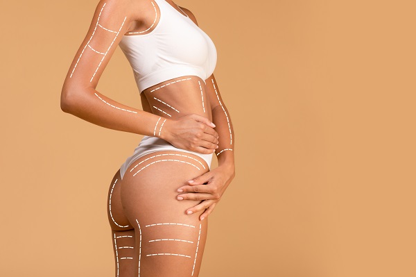 Corpo feminino vestindo lingerie branca, marcado para fazer lipoaspiração.