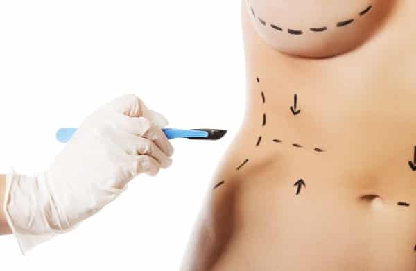 Médico, usando luvas brancas, aproxima o bisturi do corpo de uma mulher que está marcado com as linhas para cirurgia plástica.