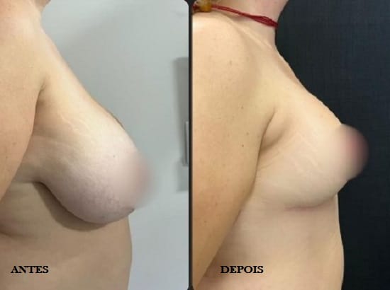 Duas imagens de uma mastopexia sem prótese. A primeira, com mamas volumosas e flácidas. A segunda com mamas reposicionadas e harmônicas.