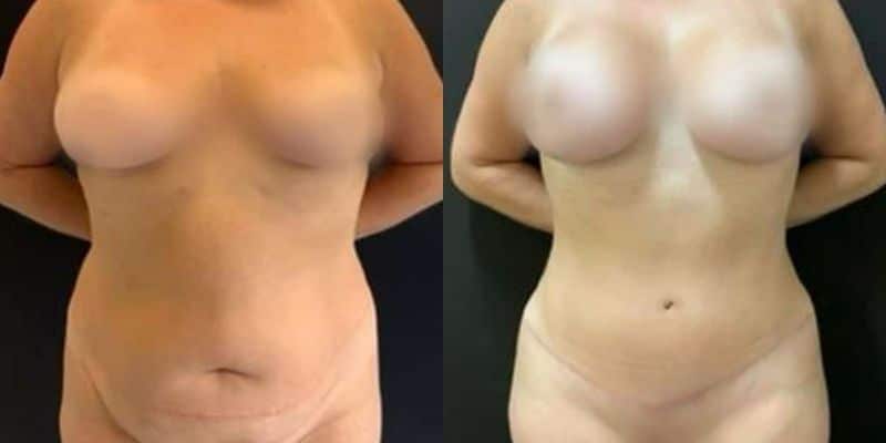 Abdomen-15
