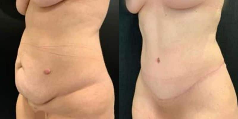 Abdomen-18