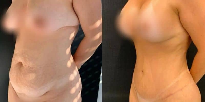 Abdomen-24