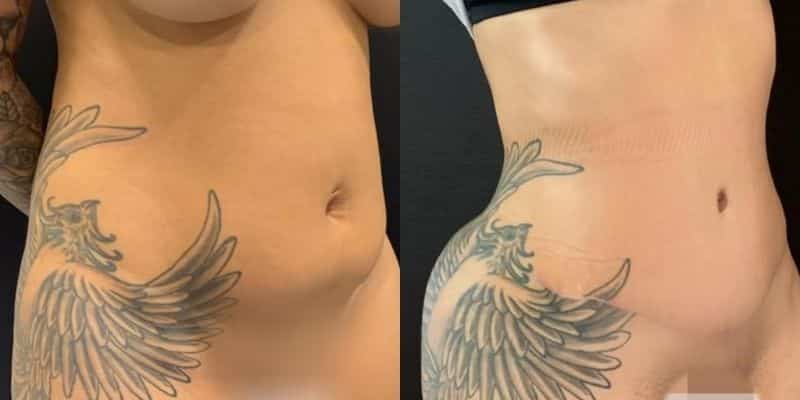 Abdomen-25