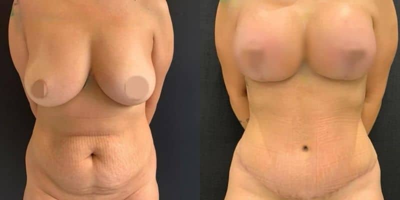 Abdomen-28