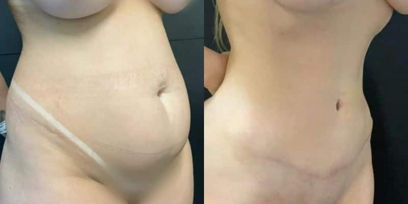 Abdomen-9