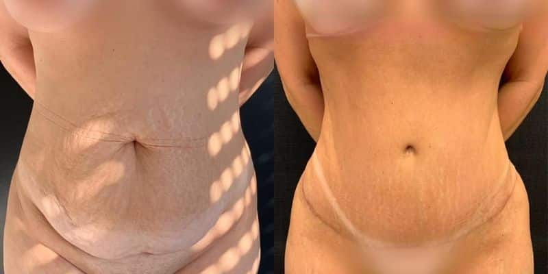 Abdomen