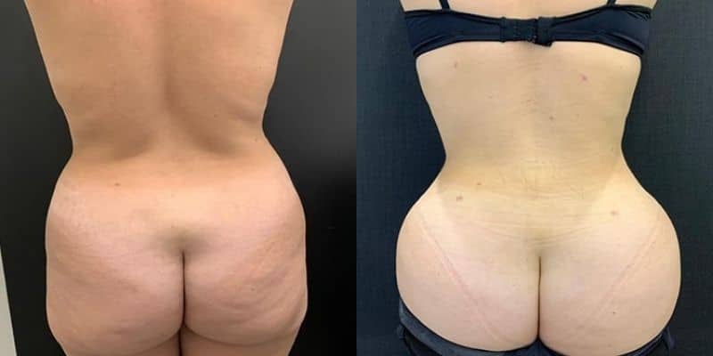 Gluteos-5
