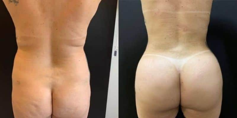 Gluteos