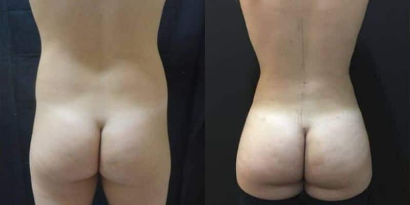 Lipo-1