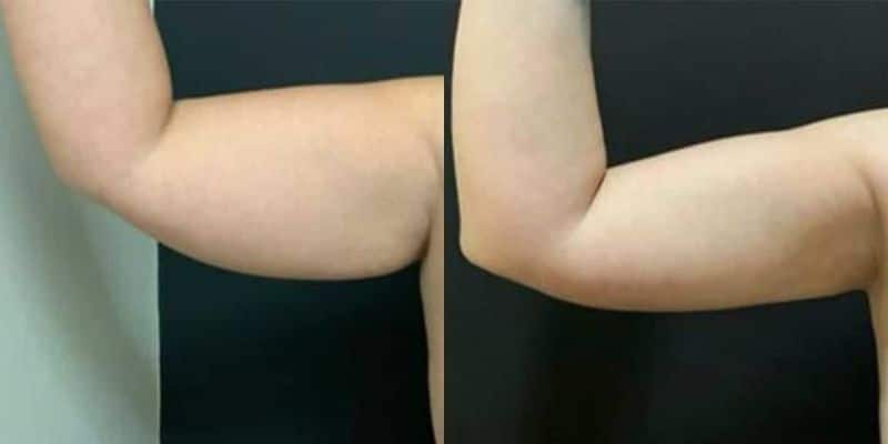 Lipo-10