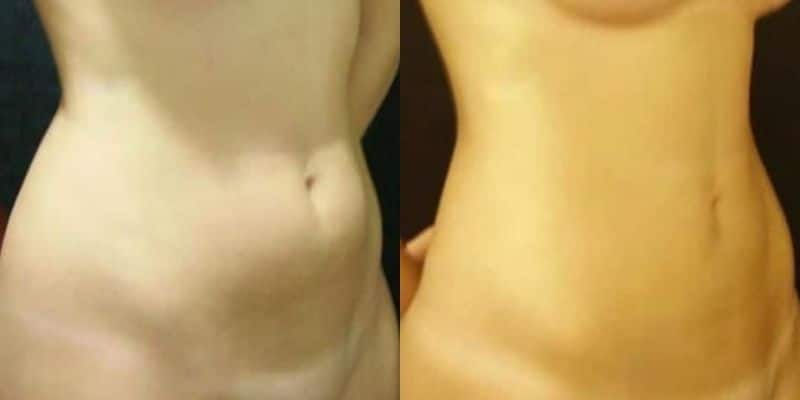 Lipo-13