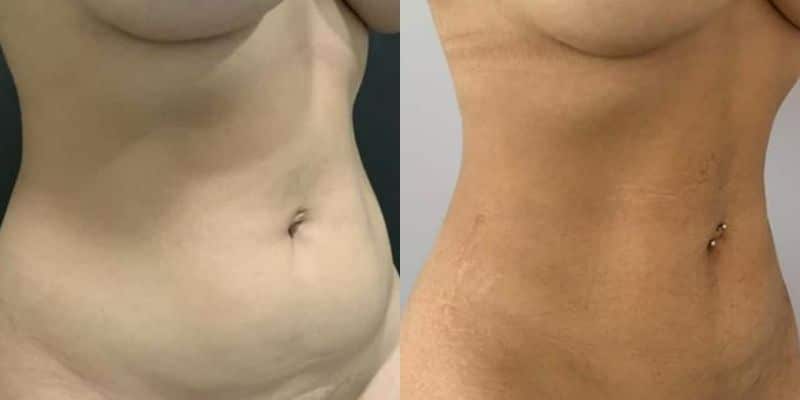 Lipo-14