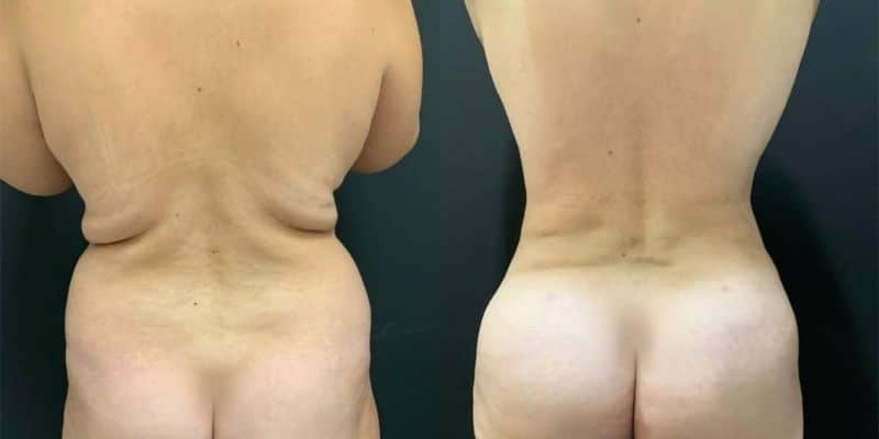 Lipo-20