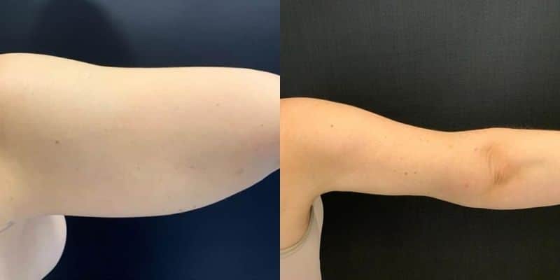 Lipo-21