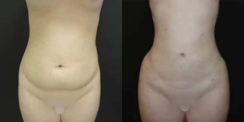 Lipo-22