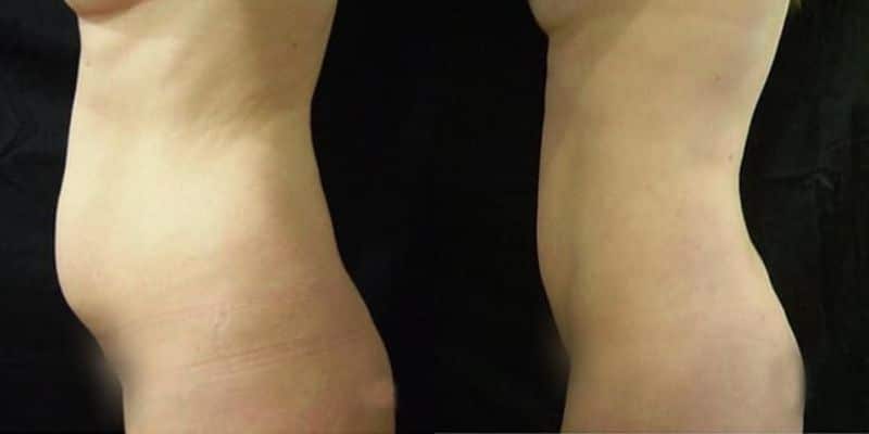Lipo-28