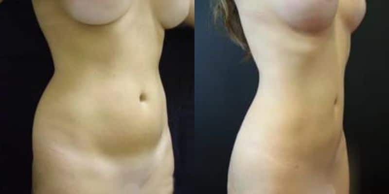 Lipo-5