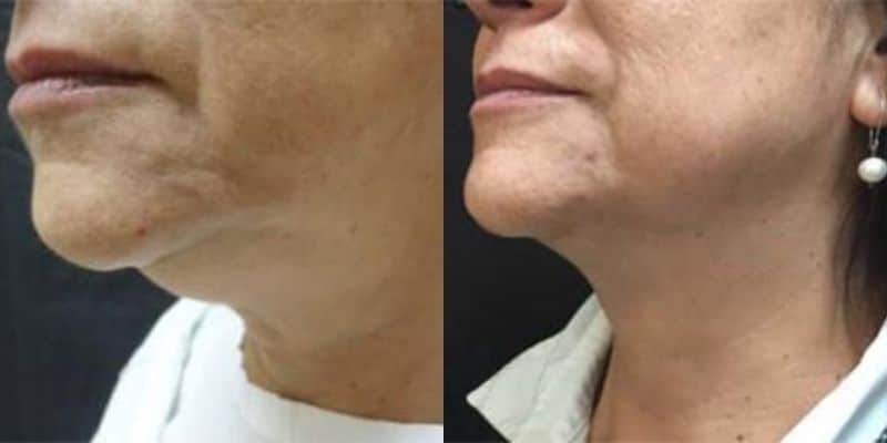 Lipo-6