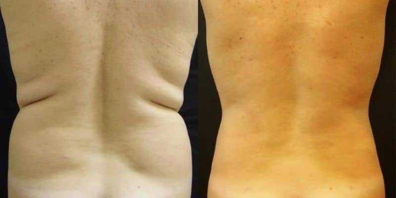 Lipo-9